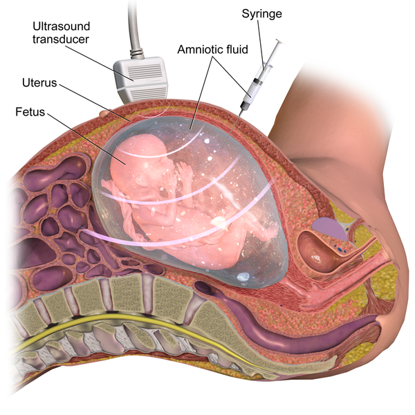 File:Amniocentesis.png