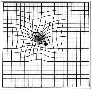 Amsler grid as it might appear to someone with...