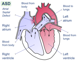 کاتتریزاسیون قلبی