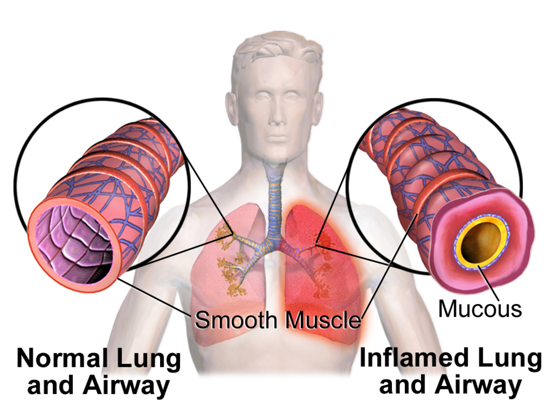 Bronchoconstriction