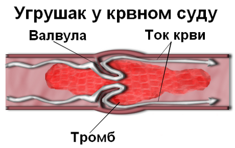 Згрушавање крви у крвном суду