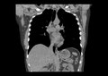 CT scan of the thorax (coronal mediastinal window)