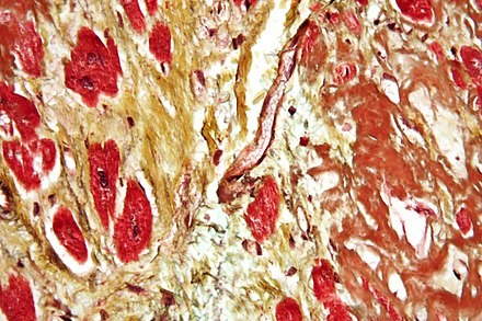 Micrograph of a heart with fibrosis (yellow) and amyloidosis (brown) using Movat's stain.