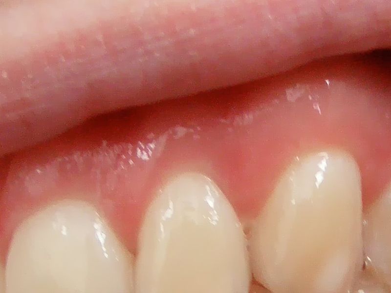 White Spots On Gums In Mouth 20
