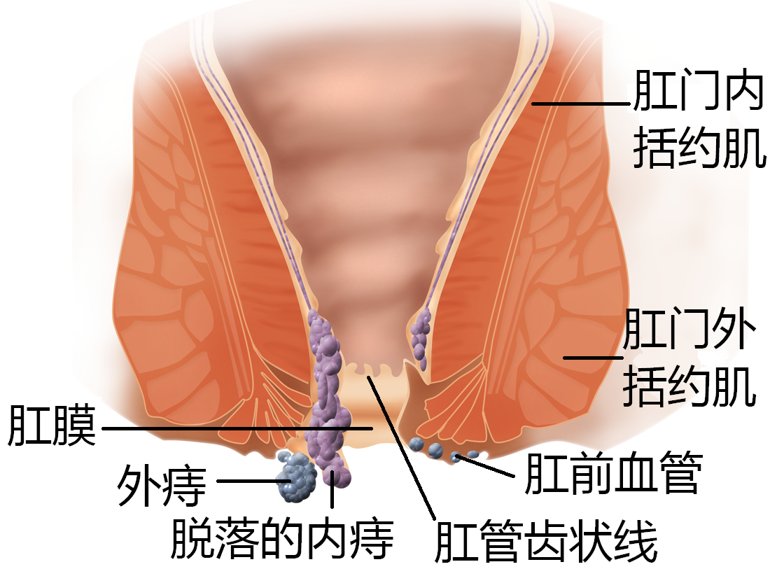 痔疮