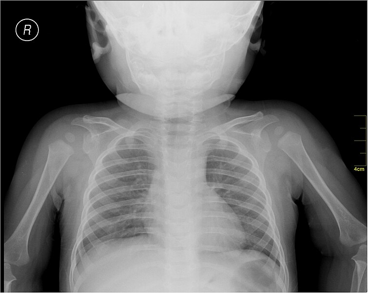 File:Medical X-Ray imaging XCY07 nevit.jpg