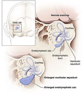 Pendred syndrome Medical condition