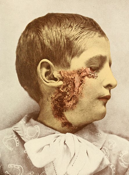 File:Photographic atlas of the diseases of the skin a series of ninety-six plates, comprising nearly two hundred illustrations, with descriptive text, and a treatise on cutaneous therapeutics (1905) (14781134291) (cropped).jpg