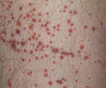 Red, non-blanching skin lesions on the upper leg