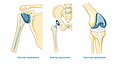 Chirurgia sostitutiva - Sostituzione totale della spalla, dell'anca e del ginocchio