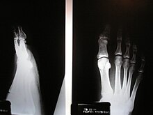 Roentgen - Foot, thumb broken.jpg