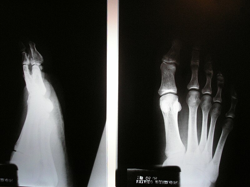 File:Roentgen - Foot, thumb broken.jpg