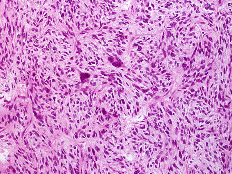 File:Skin Tumors-PA030916.jpg