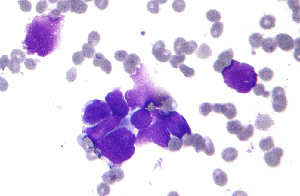 Small-cell Carcinoma-avatar