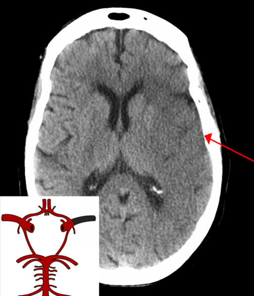 File:StrokeMCA overlay.png