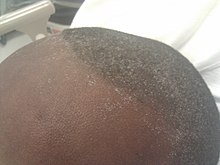 Uremic frost on the head in someone with chronic kidney disease Uremic frost on forehead and scalp of young Afro-Caribbean male.jpg