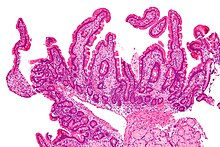 Maladie de Whipple : infiltrat de macrophages mousseux dans la lamina propria.