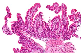 <span class="mw-page-title-main">Whipple's disease</span> Medical condition