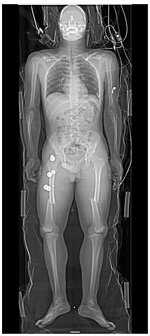 Whole-body radiograph of a major trauma case (where, however, full-body CT scan is usually preferable), showing bilateral femur fractures. Whole body radiograph in trauma.jpg