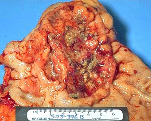 Adenocarcinoma, stomach, gross pathology IMG0037a lores.jpg