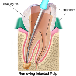 Endodontic therapy of a root canal.