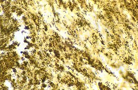 Bartonella henselae бациллы в ткани сердечного клапана пациента с отрицательным посевом на эндокардит: бациллы выглядят как чёрные гранулы.