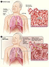 Em cima: pulmões saudáveis com pormenor em corte dos bronquíolos e dos alvéolos pulmonares. Em baixo, as mesmas estruturas em processo de destruição pela DPOC