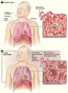 Normal lungs shown in upper diagram. Lungs damaged by COPD in lower diagram with an inset showing a cross-section of bronchioles blocked by mucus and damaged alveoli. Copd 2010.jpg