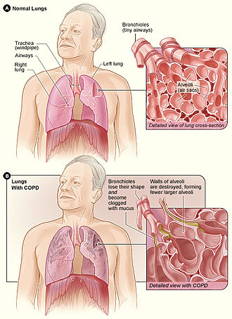 Chronische Obstructieve Longziekte Chronic Obstructive Pulmonary