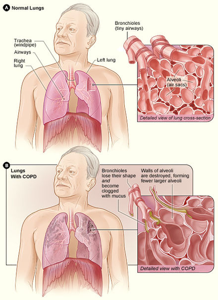 Normal lungs shown in upper diagram. Lungs damaged by COPD in lower diagram with an inset showing a cross-section of bronchioles blocked by mucus, and damaged alveoli.