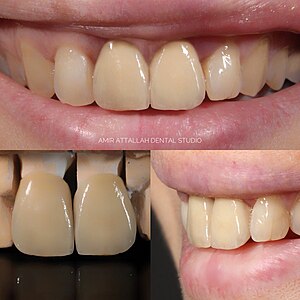 Dental Restoration Crown