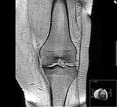 MRI of osteoarthritis in the knee, with characteristic narrowing of the joint space.