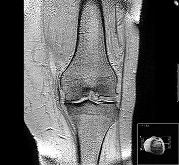 Osteoartritis