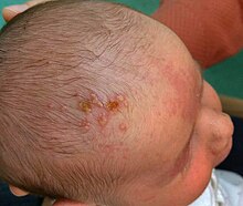 hud Advent Begivenhed Herpes simplex - Wikipedia, den frie encyklopædi