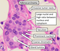 Annotated adenocarcinoma features