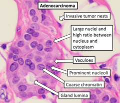 Adenocarcinoma with typical features, although they vary substantially from case to case. Histopathology of adenocarcinoma.png