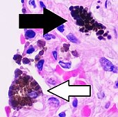 Istopatologia del macrofago antracotico nel polmone, annotato.jpg