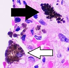 Micrograph of anthracosis, with interstitial pigment deposition (black arrow) and an anthracotic macrophage (white arrow) Histopathology of anthracotic macrophage in lung, annotated.jpg