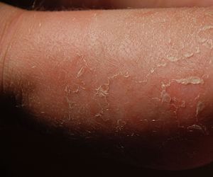 Ichthyosis bullosa siemens.jpg 