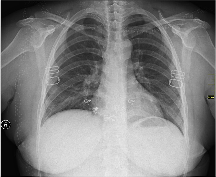 File:Medical X-Ray imaging WXD07 nevit.jpg