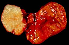 Benign tumour of the submandibular gland, also known as pleomorphic adenoma, presented as a painless neck mass in a 40-year-old man. At the left of the image is the white tumor with its characteristic cartilaginous cut surface. To the right is the normally lobated submandibular salivary gland. Mixed Tumor of the Salivary Gland.jpg