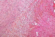 Cell morphology observed in all nerve root schwannomas Nerve root schwannoma - intermed mag.jpg