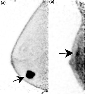 Positron emission mammography Imaging procedure used to detect breast cancer