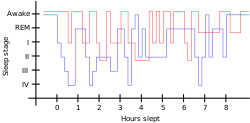 Sleep pattern of a restless legs syndrome patient (red) vs. a healthy sleep pattern (blue).