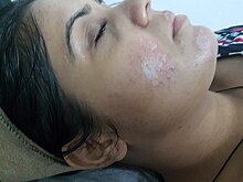 Chemical peeling for acne