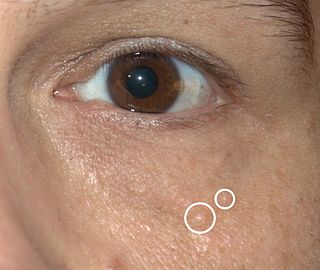 <span class="mw-page-title-main">Syringoma</span> Medical condition