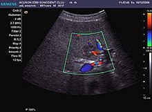 Fig. 11. Early hepatocellular carcinoma (2D, CFM). The 2D examination reveals a solid, hypoechoic nodule in IVth liver segment, without encapsulation. CFM shows a central vessel with ramifications to the periphery. The underlying liver is cirrhotic. Ultrasonography of early hepatocellular carcinoma.jpg