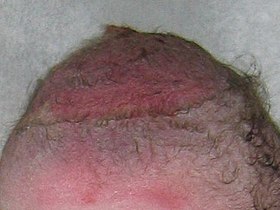 Vacuum Extraction bruised scalp.JPG