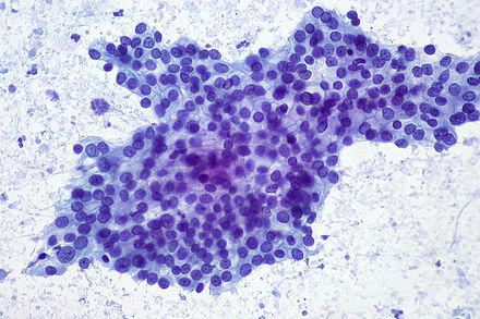 Fine needle aspiration of well-differentiated pancreatic adenocarcinoma, showing a flat sheet with prominent honeycombing. The disorganization, nuclear overlapping, and lack of uniform nuclear spacing provides a clue that is this adenocarcinoma (as opposed to non-neoplastic duct epithelium).