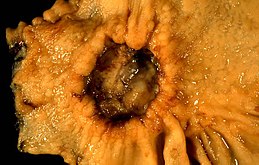 Adenocarcinoma of the stomach.jpg